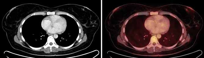 Na tomto případu je patrné, že v možnostech PET/ CT je i dia gnostika drobných maligních nádorů prsu, které nebyly dia gnostikovány cílenými vyšetřeními.