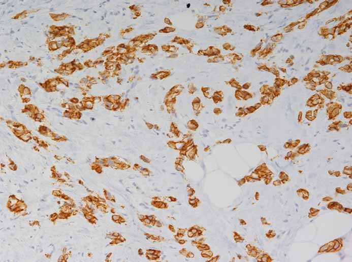 V imunohistochemickém průkazu je zřejmá vysoká oeverxprese HER2 (3+). Obr. 5.