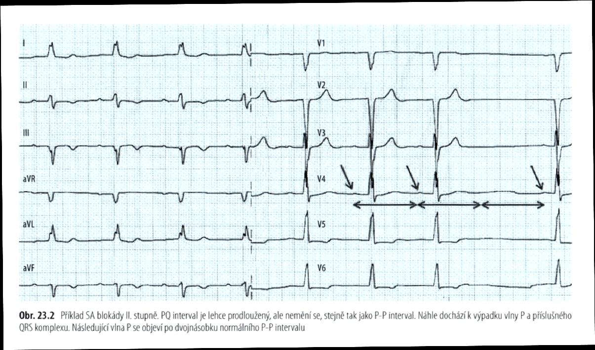 Obrázek 18: Sinusová tachykardie (Zdroj: Bělohlávek, 2014 s.