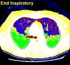 Hyperinflation during Low Tidal Volume Ventilation