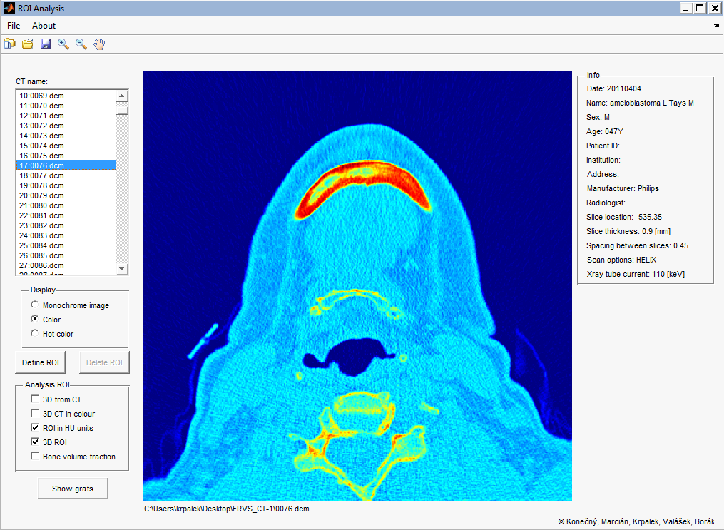 4.3.1 Zjištění HU jednotek v programu ROI Analysis Pro demonstraci zjištění HU jednotek budou použity CT snímky dolní
