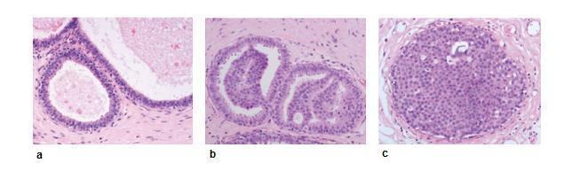 diferenciace). Třetím znakem ADH je pak její velikost. Podle ní se ADH diferenciálně diagnosticky odlišuje od low-grade DCIS.