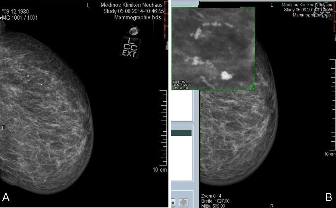 Obr. 9 Mamografický obraz high-grade DCIS na digitálním snímku (a) a následné zvětšení v režimu lupa (b): Průkaz jemných pleomorfních kalcifikací v segmentální distribuci (archiv Patricia