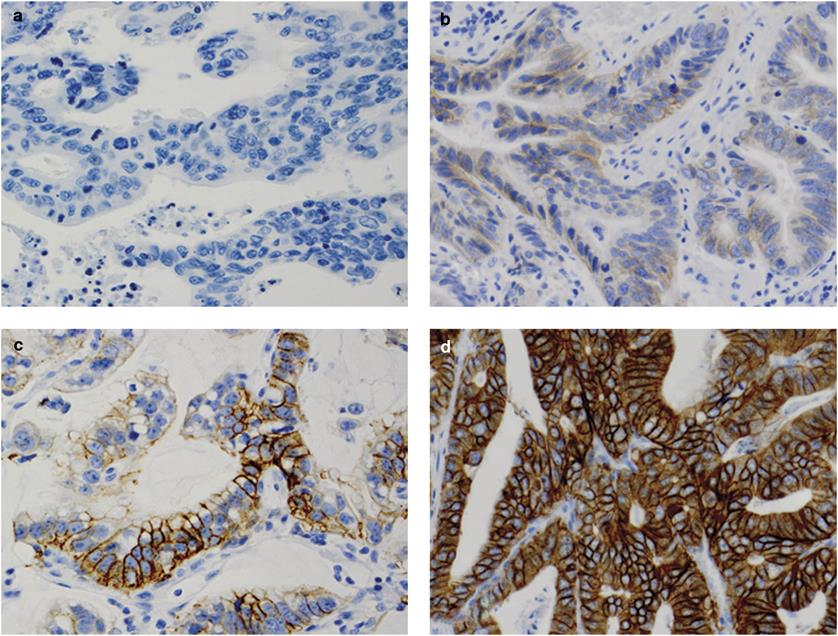 Obr. 13 Imunohistochemická vizualizace HER2 na buněčné membráně. Výsledek je semikvantitativně ohodnocen jako 0 (a), 1+ (b) = negativní, 2+ (c) = hraniční a nebo 3+ (d) = pozitivní.