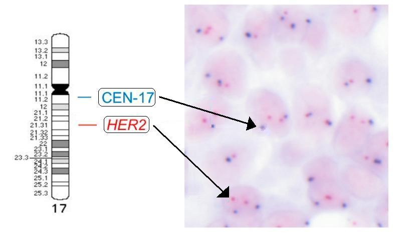 Obr. 14 Chromogenní in situ hybridizace (CISH) analyzující počet kopií HER2 genu v buněčném jádře. Jako kontrola metody slouží barvení centromer 17. chromozomu (CEN-17).