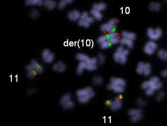 Klon 2. 48,XX,del(9)(p?),+del(9)(p?),der(10)t(9;10)(p