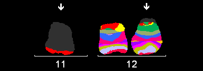 9p22 pter 12p13 pter FISH s CEP 11/LSI TEL: Translokace proximální části genu TEL na chromozom 11.