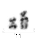 Derivovaný chromozom 11 byl v tomto případě tvořen pouze genetickým materiálem 11. chromozomu s amplifikací MLL genu v oblasti q23 (obr.č.10, příloha č. 2). Obr.č.10 Derivovaný chromozom 11 u pacienta č.