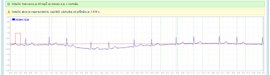 Telemonitoring EKG Automatická detekce