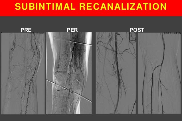 Zdroj : http://circinterventions.ahajournals.