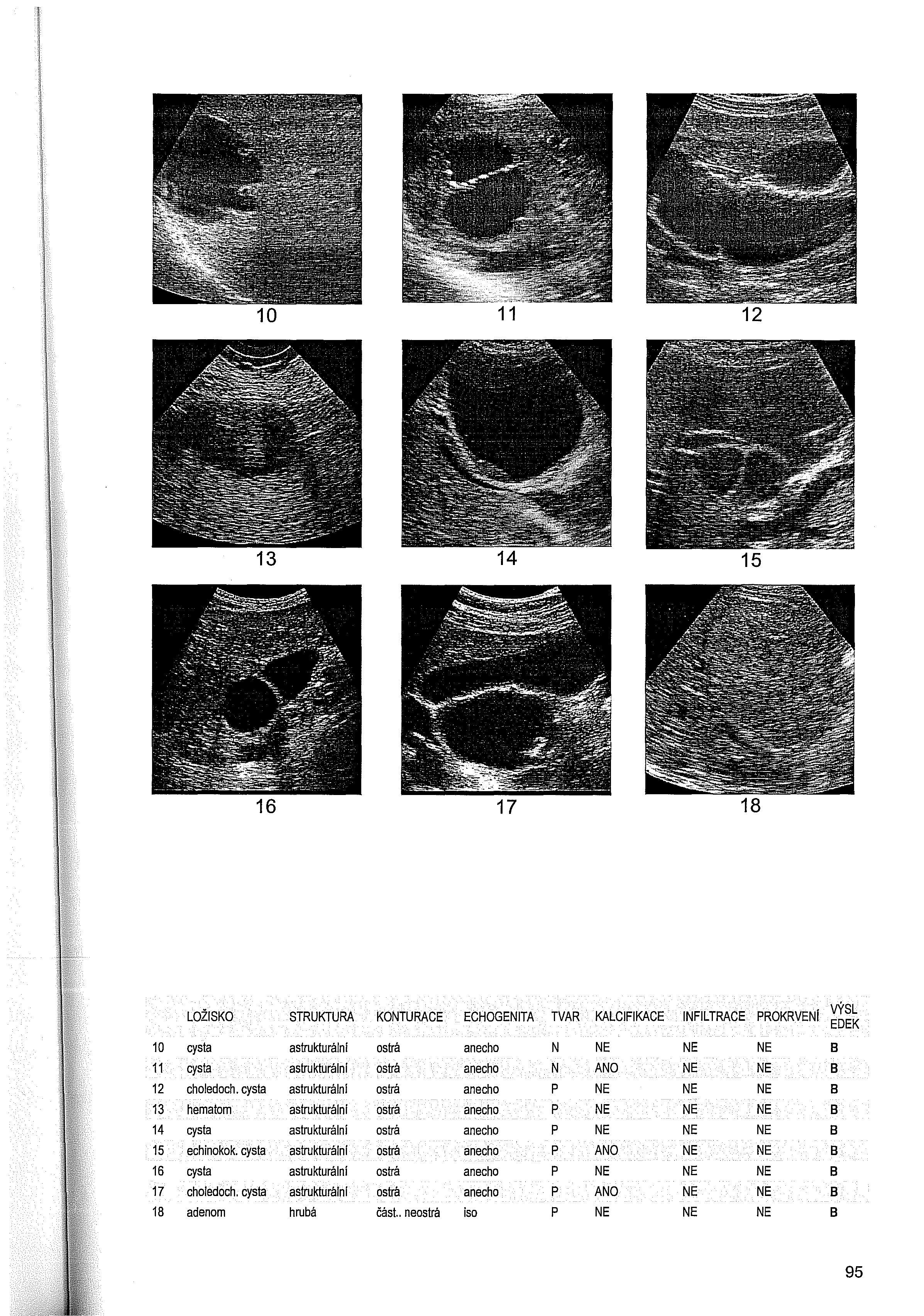 10 11 12 13 14 15 16 17 18 LOŽISKO STRUKTURA KONTURACE ECHOGENITA TVAR KALCIFIKACE INFILTRACE PROKRVENI 10 cysta astrukturálnl ostrá anecho N 8 11 cysta astrukturálnl ostrá anecho N 8 12 choledoch.