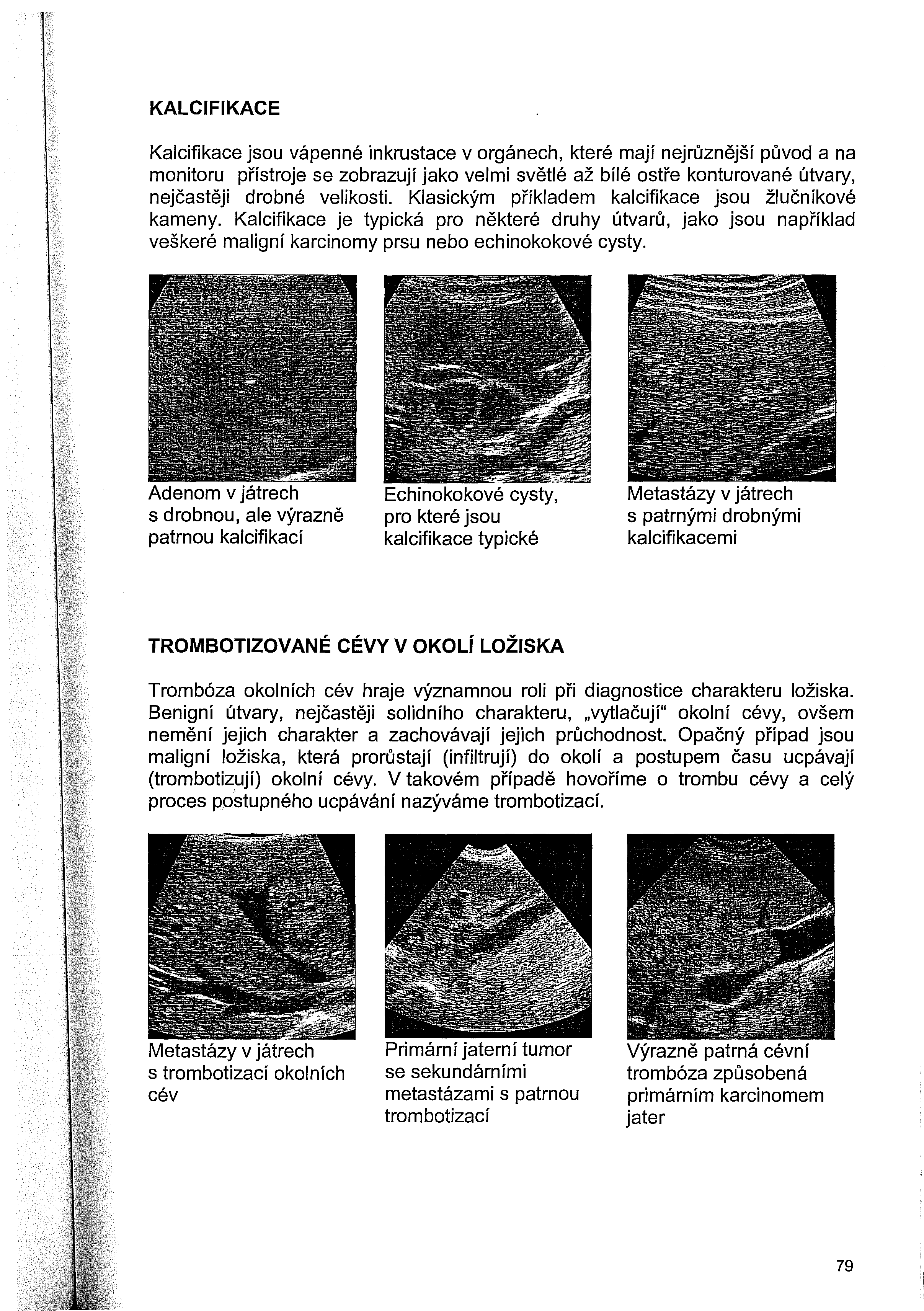 KALCIFIKACE Kalcifikace jsou vápenné inkrustace v orgánech, které mají nejrůznější původ a na monitoru přístroje se zobrazují jako velmi světlé až bílé ostře konturované útvary, nejčastěji drobné