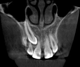 MPR řezy jsou používány pro diagnostiku kloubních patologií, obzvlášť při diagnostice patologických kostních změn [108].