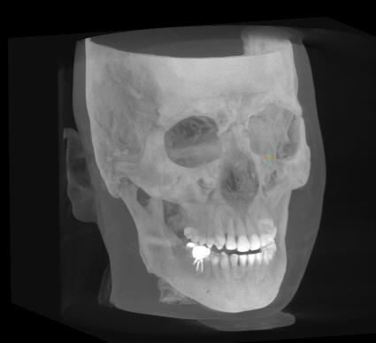 MIP se používá i při tvorbě kefalometrických snímků. Dobře zobrazuje obrysy maxilofaciální oblasti a proto se používá na topografické určení bodů hlavně na zaoblených strukturách, jako jsou např.