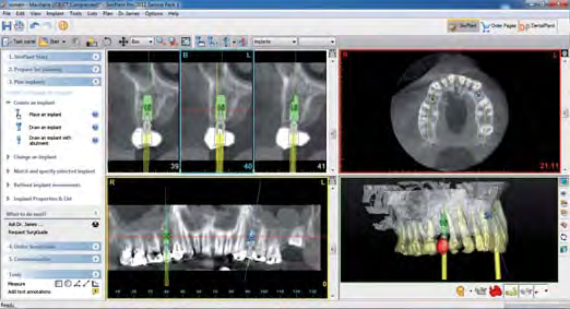 zobrazení kompatibilních implantátů, pilířů a