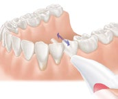 Předtím si nechte u svého zubního lékaře nebo dentální hygienistky předvést správné použití zubní nitě.