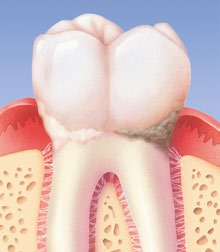 podrážděná, zarudlá a oteklá dáseň zubní kámen zubní plak Zánět dásní