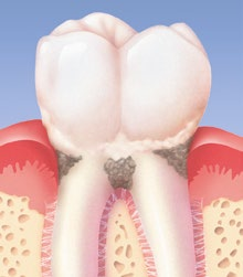 na zubech se ukládá nejprve málo viditelný, později zabarvený zubní povlak.