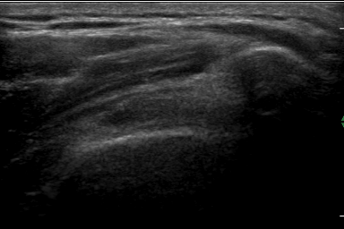 Impingement syndrom Subacromiální impingement -při 60 flexi dopředu,60