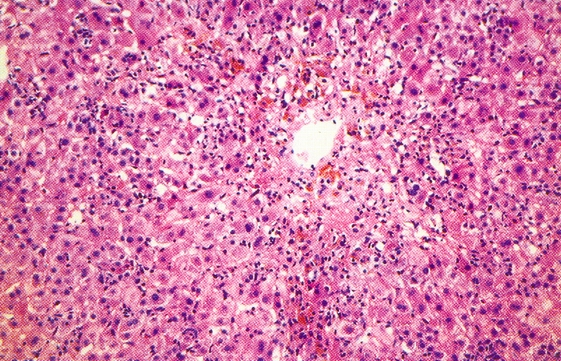 Přílohy Obrázek č. 1 Typický bioptický nález v jaterní tkáni svědčící pro virovou hepatitidu.