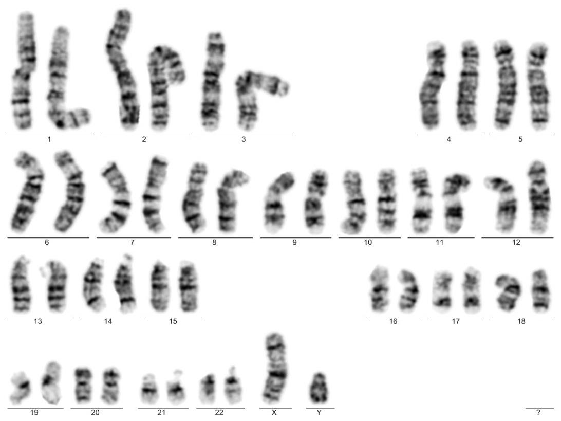 2.3 Diagnostické metody 2.3.1 Karyotypizace Karyotyp je soubor chromozomů v jádře eukaryotických buněk. Stanovení karyotypu tzv.