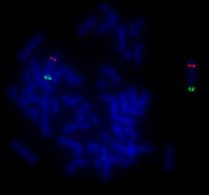 LSI sonda 5q31/5p15.2 (Abbott Molecular) hybridizuje na chromozóm 5 ve dvou oblastech. První oblastí je 5p15.