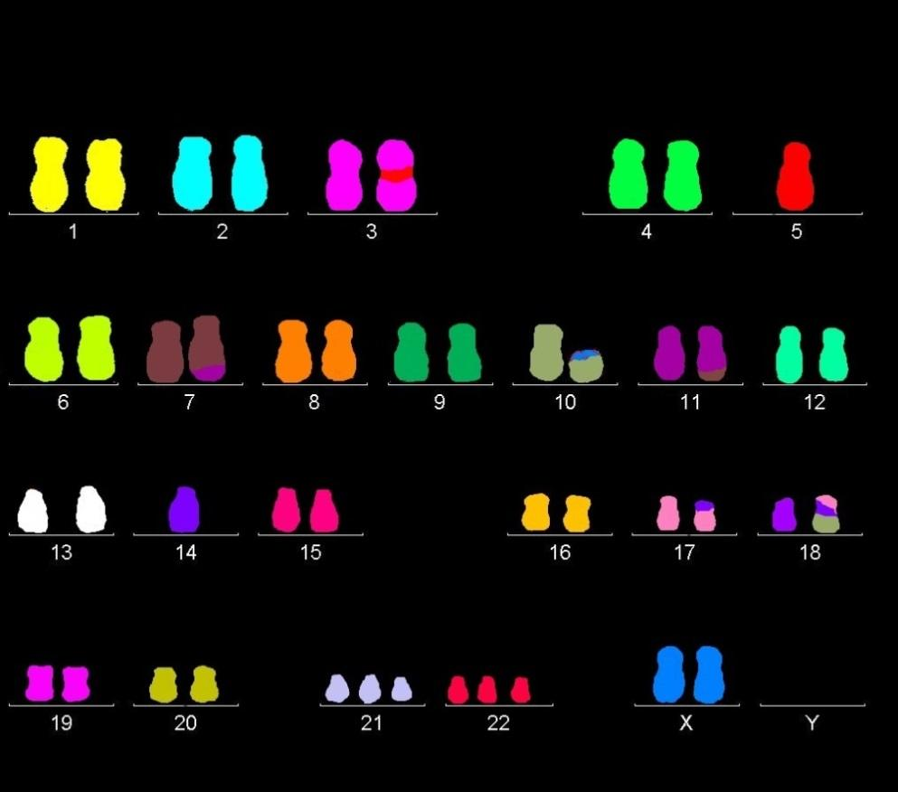 3. klon: 44,XX,der(3;5)(3pter 3q?12::5p11 5q?12::3q?13 3q?27::7?q??q?),t(6;12)(q?;p?),- 7,t(7;11)(q?31;?),der(9)t(3;9)(q?;q?31),?dic(12;18)(?;?),+mar[2] Obr. 15 mfish - 1. odběr, 2.