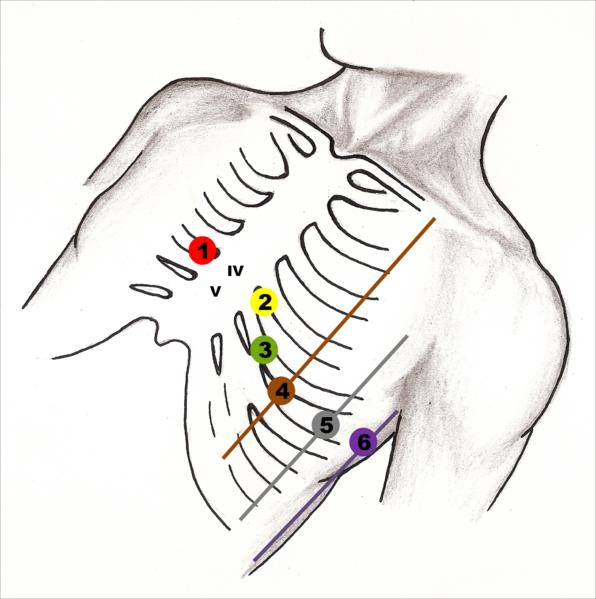 Obrázek 5: Ukázka zapojení hrudních svodů. [14] Zesílené končetinové svody jsou tvořeny třemi elektrodami. Na pravé ruce (avr), na levé ruce (avl) a na levé noze (avf).