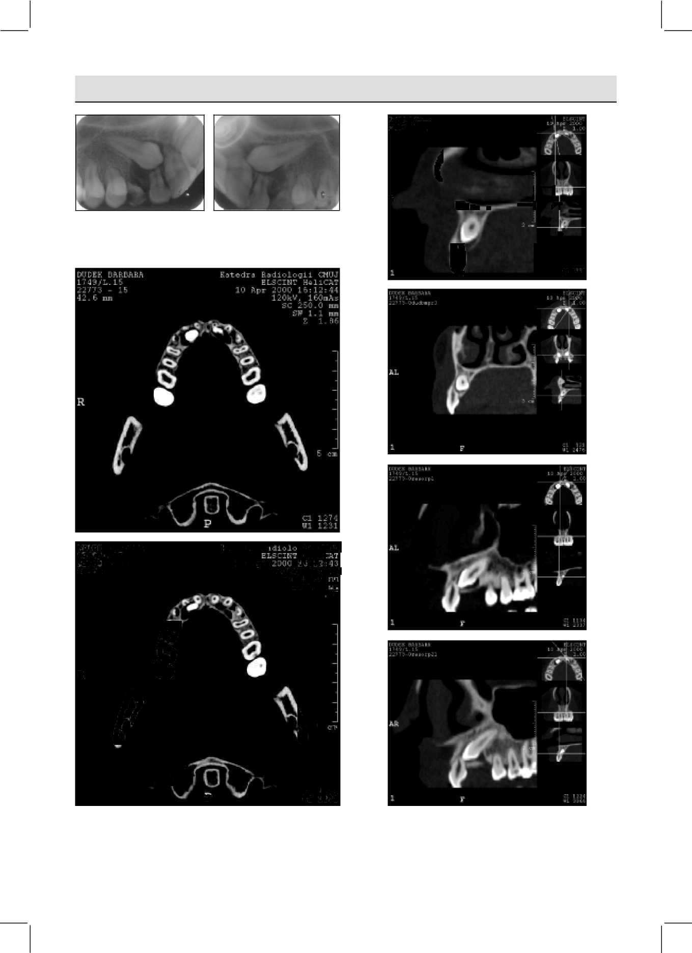 ORTODONCIE Odborná práce ročník 10 č. 3. 2001 T-^l 1T PL U.HHPHI 5 JÍ 1 '. WT+ Hf pl Fig. 5B. Intraoral radiograms demonstrate resorption ofboth lateral incisors Obr. 5B. Intraorální rtg zobrazují resorpci obou postranních řezáků.