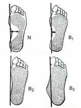 patologického postavení kosti. Takto "nefunkční" noha může později v dospělosti vést k dalším deformitám jako je hallux valgus, kladívkovité či drápovité prsty.