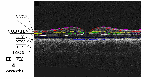 Obr. 38 Vrstvy sítnice shora dolů: vrstva vláken zrakového nervu (VVZN), vrstva gangliových buněk (VGB) spolu s vnitřní pleteňovou vrstvou (TPV), vnitřní jádrová vrstva