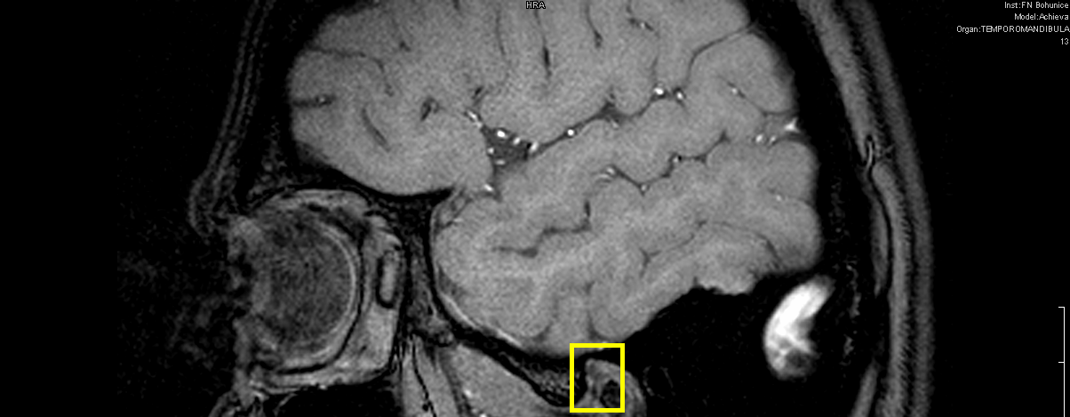 snímku lidské hlavy s vyznačenou oblastí kloubního disku. Obr.