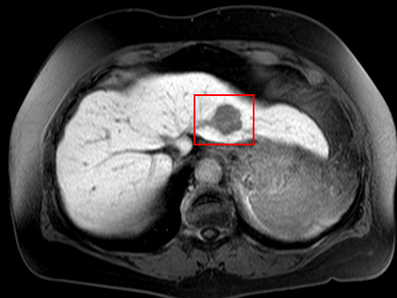 MR obrazy jater vykazují dobrý kontrast. Problémem je ohraničení pouze oblasti tumoru hladkou uzavřenou křivkou tak, aby křivka neohraničovala žádné další tkáně.