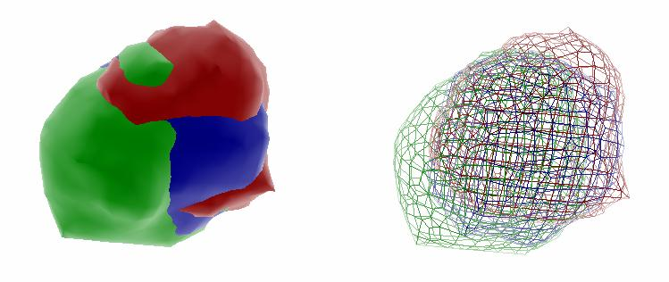 Obr. 49 Výsledek trojrozměrné rekonstrukce tumoru s předchozí manuální segmentací ve třech rovinách snímání obrazu, vlevo povrchový model, vpravo síťový model.