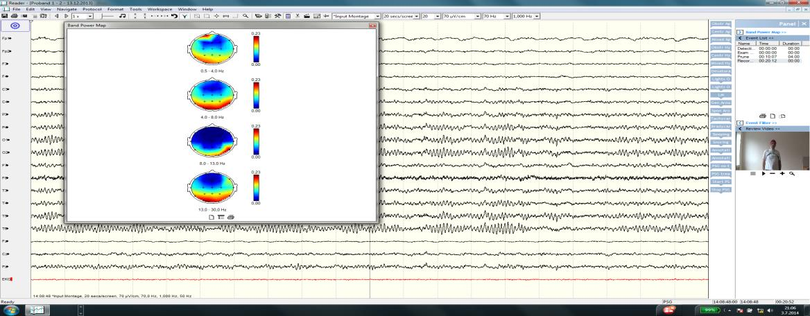 Klidové EEG a BM po