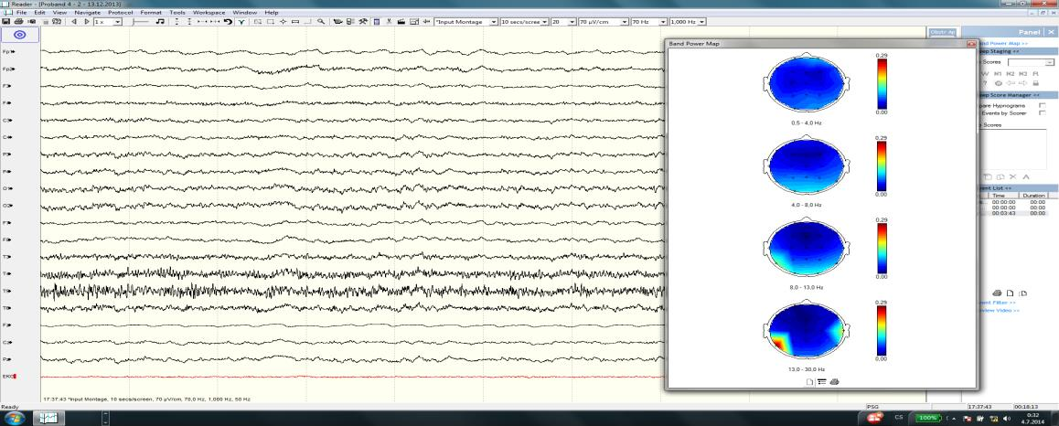 Proband 4 Klidové EEG a BM