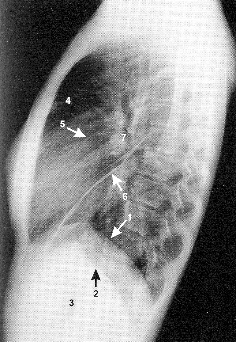 Prostý snímek - RTG anatomie 1. pravá polovina bránice 2. levá polovina bránic 3.