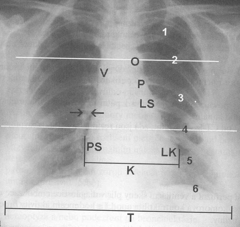 Chorobné změny - srdce rozšíření celkové nebo jednotlivých oddílů KTI přesahuje 0,5 hypertrofie / dilatace perikardiální tekutina