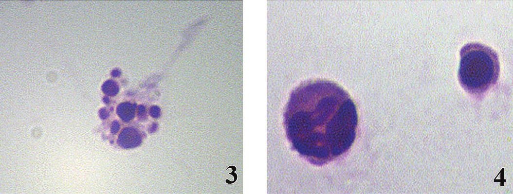 3: Apoptotický neutrofil ve stadium zeiosis. Panoptické barvení dle Pappenheima, zvětšení 1000x. 4: Apoptotické tělísko neutrofilu (vpravo) a normální neutrofil.