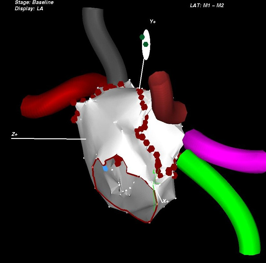 v elektroanatomické mapě byly znázorněny plicní žíly a jejich