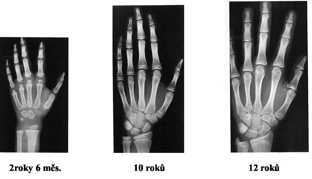 KOSTNÍ VĚK (RTG LEVÉHO ZÁPĚSTÍ, HODNOTÍ SE STUPEŇ OSIFIKACE A POROVNÁVÁ SE S ATLASEM KOSTNÍHO VĚKU; STANOVENÍ KOSTNÍHO