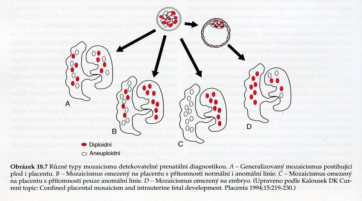 výsledků je možný rozdílný nález karyotypu embrya a extraembryonální tkáně -