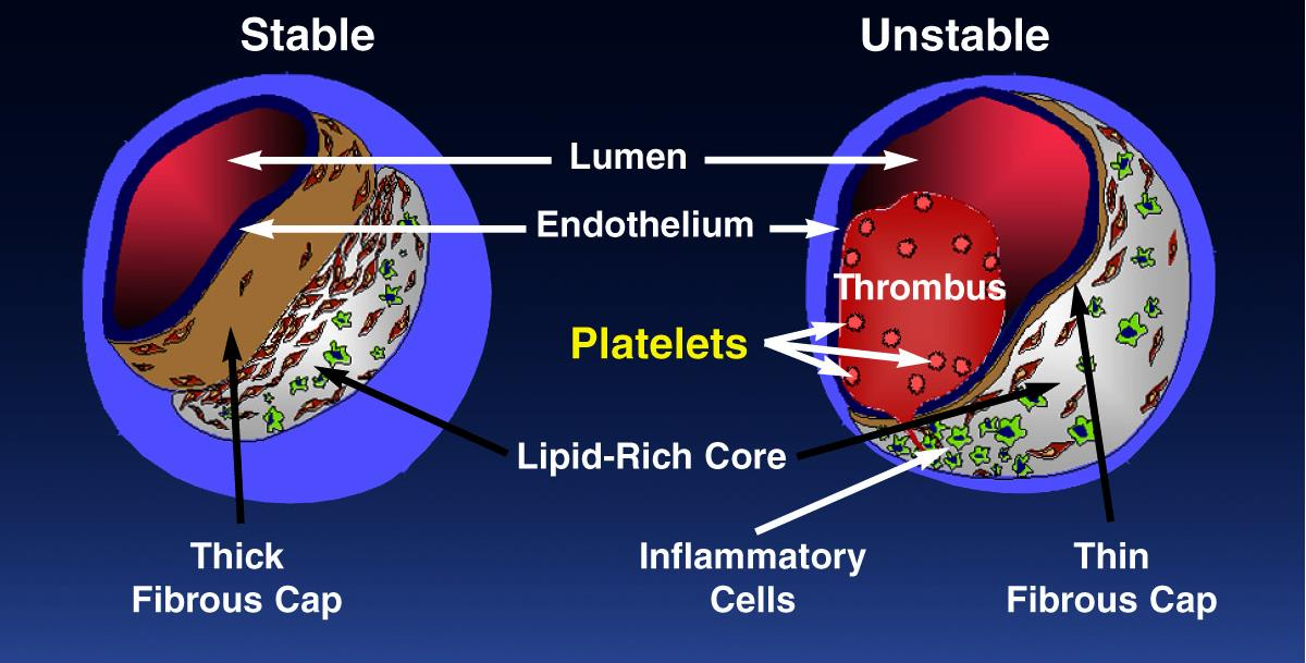 STABLE VERSUS UNSTABLE PLAQUE Falk