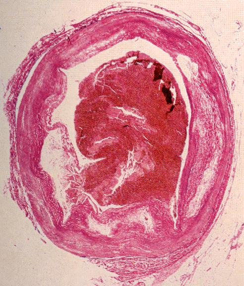 Acute coronary syndromes final classification UNSTABLE ANGINA PECTORIS (flow