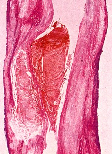 STEMI In 90% thrombus on ruptured plaque occlusion of entire vessel