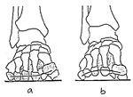která se projevuje bolestí při chůzi, zvláště na vyšším podpatku (http://www.studiozdravehoobouvani.cz/ortopedicke-vlozky/pricne-plochanoha/). Obrázek 12. Příčně plochá noha (http://www.medi-shoes.