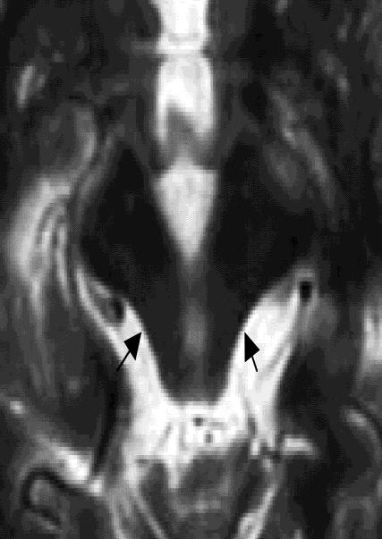 Významná (nevysvětlená) dysautonomie Těžké asymetrické příznaky parkinsonismu Relevantní strukturální abnormita bazálních ganglií v zobrazení Whippleova nemoc při PCR vyšetření likvoru Diagnostika je