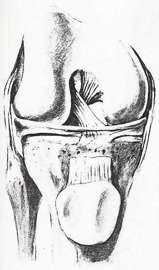 musculus popliteus (začátek svalu) 7. caput fibulae 8. capsula articularis 9. caput mediale musculi gastrocnemii 10.lig.