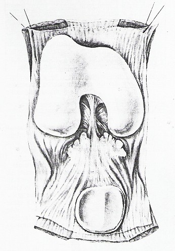 11 Plica synovialis patellaris a plicae alares Obr. 12 Bursae mucoasae kolenního kloubu (pravá strana) 1. začátek caput laterale musculi gastrocnemii 2.