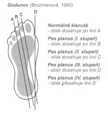 Godunov (Obrázek 14) vychází ze základní linie (linie A) spojující zadní okraj paty a střed mezi 3. a 4. prstem.